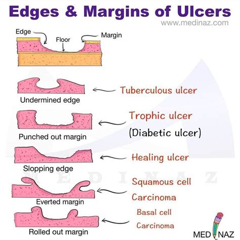 Edges And Margins Of Ulcers Ulcers Skin Ulcer Oral Pathology