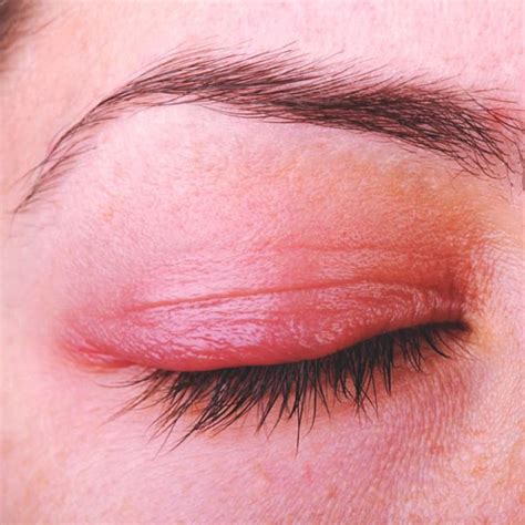 Whats Causing My Funky Eyelid Dry Eye Remedies Itchy Eyelids