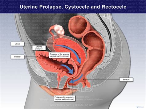 Uterine Prolapse Cystocele And Rectocele TrialExhibits Inc