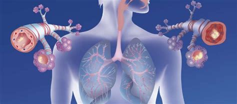 Biologic Therapy Selection For Severe Asthma Factors To Consider