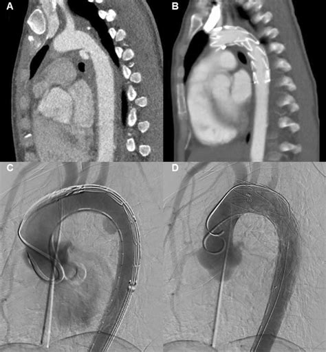 A Pre Operative Cta Scan Of The Thoracic Aorta Displaying A Grade Iii