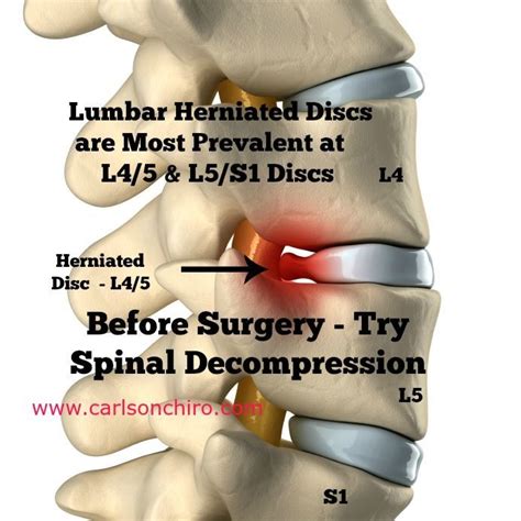 The most common l4 l5 pain symptoms. Pin on Disc Prolapse: Slipped Bulged Disc