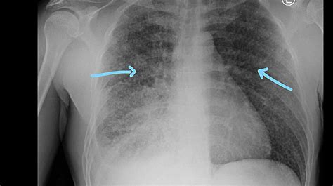 Cureus Miliary Tuberculosis In A Young Patient Lets Not Forget The