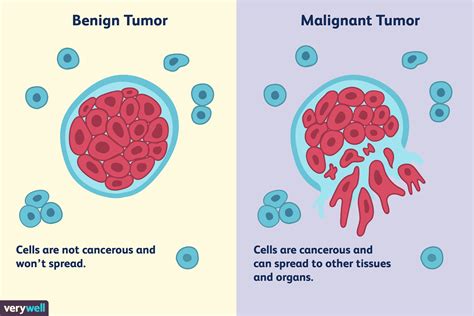 Benign Vs Malignant Tumors Causes And Treatments