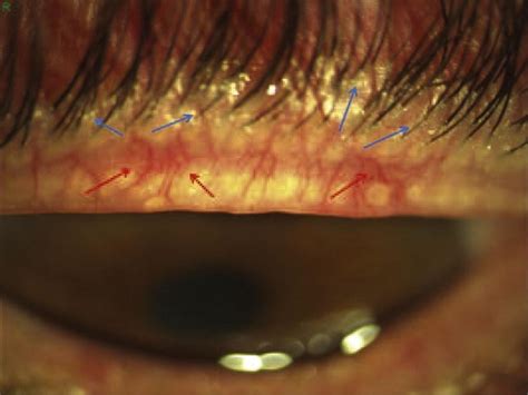 Anterior Blepharitis Of A Mixed Type Of The Upper Eyelid This Shows A