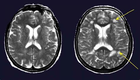 White Matter Lesions On Cerebral Mri Cerebral Mri Of Two Women 67