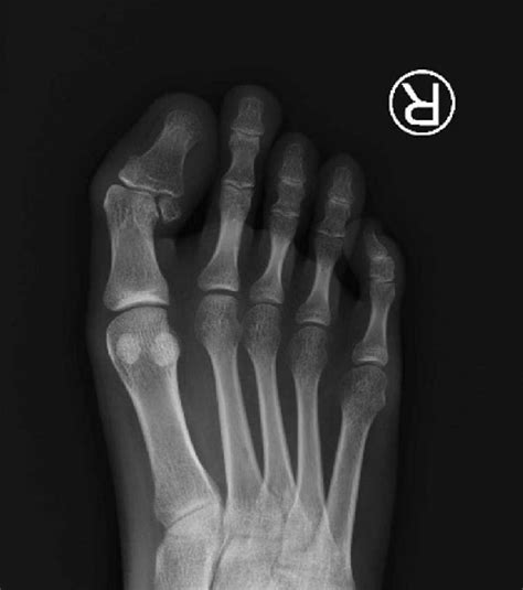 Lateral Deviation Of Great Toe Interphalangeal Joint As Much As 2869⁰