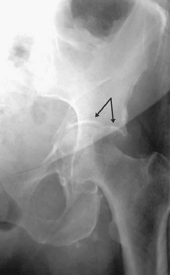 Acetabular Fractures Radiology Key