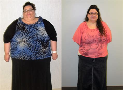 Gastric Bypass Surgery Before And After In St Louis St Louis Bariatrics