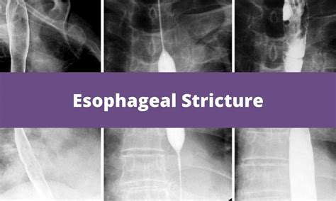 Esophageal Stricture Medical Junction