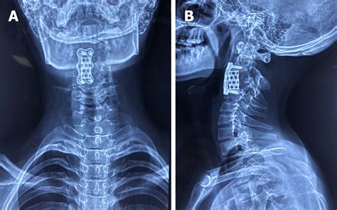 Anterior Cervical Corpectomy And Fusion Accf Best Spine Surgeon In Mumbai Top Spine