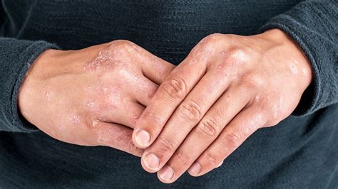 Soligenix Expands Synthetic Hypericin Psoriasis Study