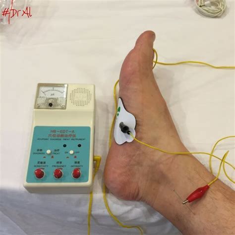 Percutaneous Posterior Tibial Nerve Stimulation Ptns Or