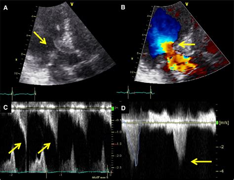 Cardiogenic Shock Induced By Basal Septal Hypertrophy And Left