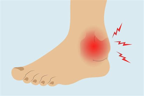 Arthritis In The Ankle Treatments Exercises And Home Remedies