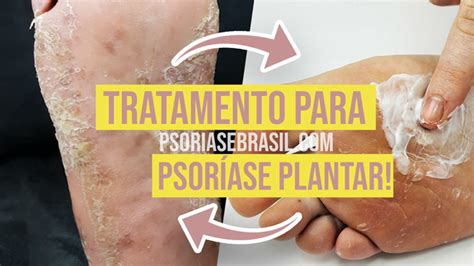 Saiba Como Lidar Com A Psoríase Plantar Psoríase Brasil