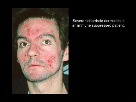 Seborrheic Dermatitis The Clinical Advisor