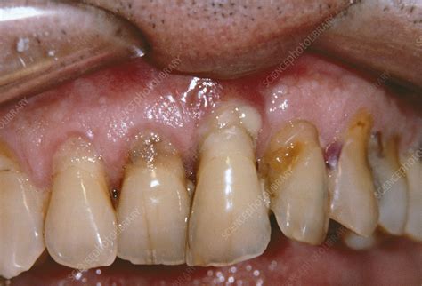 Periodontal Disease Stock Image M Science Photo Library