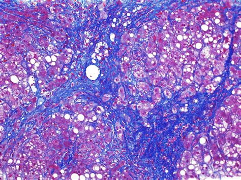 Pathology Outlines Nonalcoholic Fatty Liver Disease