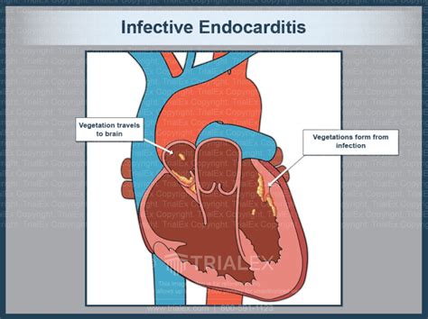 Infective Endocarditis Trialexhibits Inc