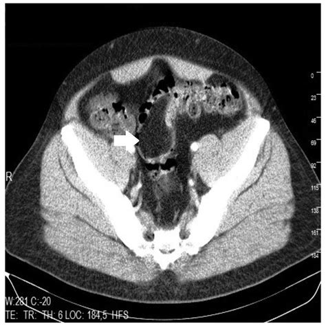 Giant Colonic Lipoma With Prolapse Through The Rectum Treated By