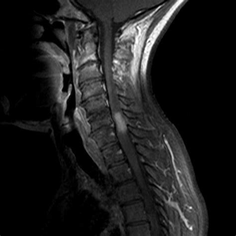 MRI Of The Cervical Spine Sagittal View Contrast Enhancement In The