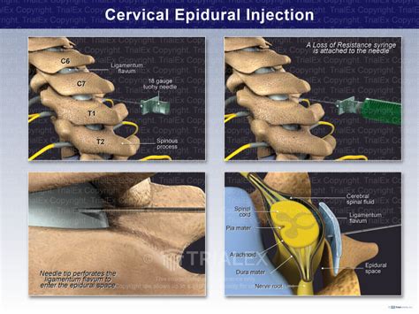 Cervical Epidural Injection Trial Exhibits Inc
