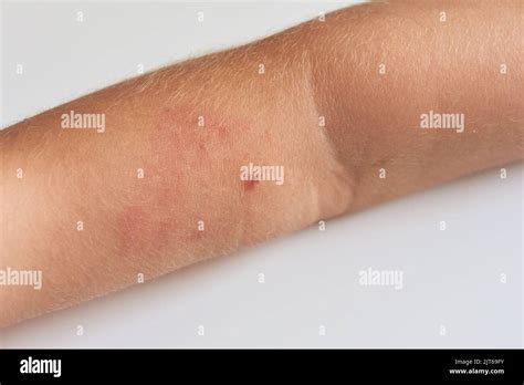 Insect Bite On Arm Of Child With Allergic Reaction Stock Photo Alamy