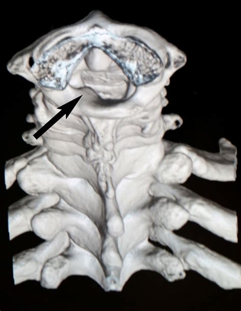 Cervical Spine CT Scan Showing Expansile Bone Exostosis Arising From Download Scientific