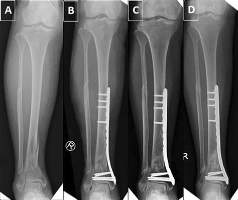 Valgus Malunion Seen In A Varus Fracture Pattern With Medial Plating A