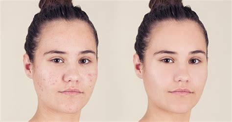 How To Cover Up Acne With Makeup Loréal Paris