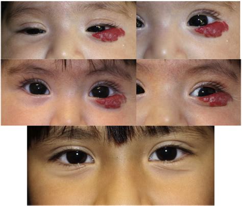 Hemangiomas And The Eye Clinics In Dermatology
