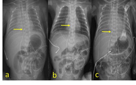 Cureus Ct And Sonographic Findings Of A Calcified Fibrin Sheath From