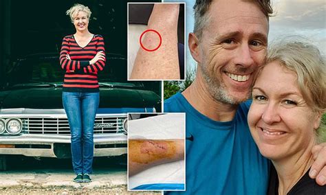 Mums Warning After Tiny Wart She Tried To Treat With Chemist Dry