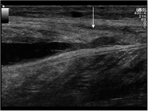 Leg Hematoma Ultrasound