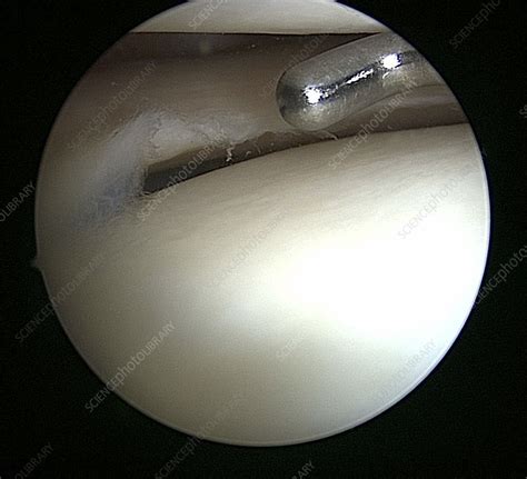 Arthroscopic Knee Surgery Stock Image C0504992 Science Photo Library