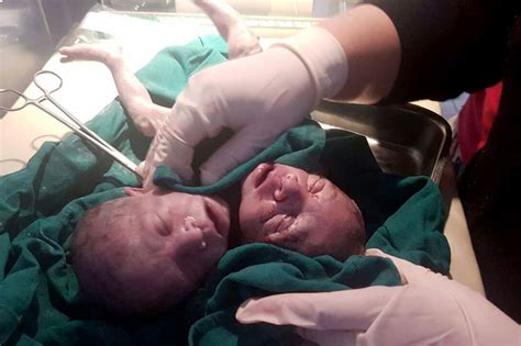 Baby Born With Two Heads Declared A T From God After