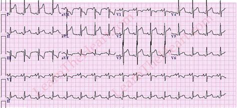 Pericarditis ECG Example Learn The Heart