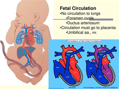 Fetal Circulation Pda Image To U