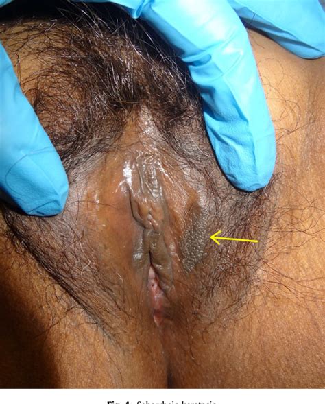 Figure 4 From Benign Lumps And Bumps Of The Vulva A Review