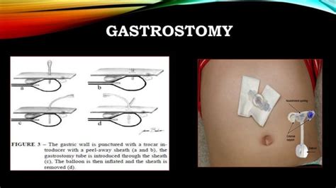 Presentation On Gastrostomy And Jejunostomy Feeding Ppt