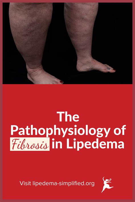 The Pathophysiology Of Fibrosis In Lipedema In 2021 Lipedema