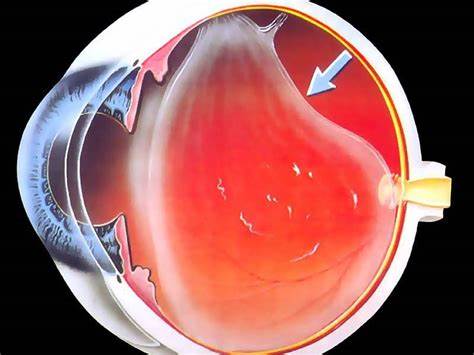Деструкция стекловидного тела диета