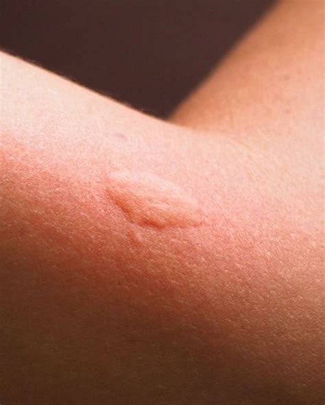 12 Common Bug Bite Pictures How To Id Insect Bites And Stings