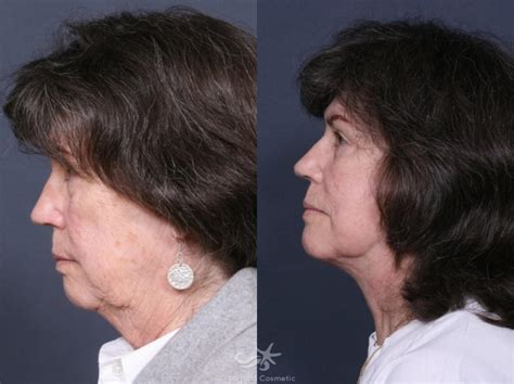Facelift Before And After Pictures Result 475 San Diego Ca La
