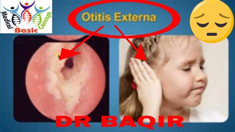 Otitis Externa With Different Types Youtube