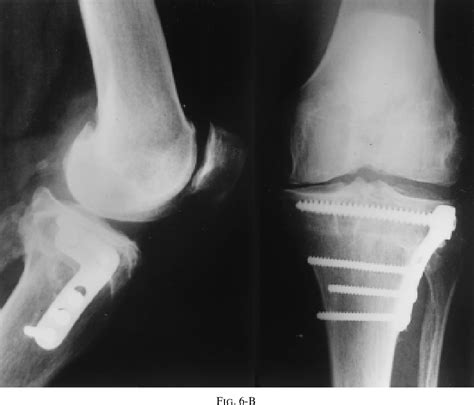 Figure 6 From High Tibial Osteotomy With A Calibrated Osteotomy Guide