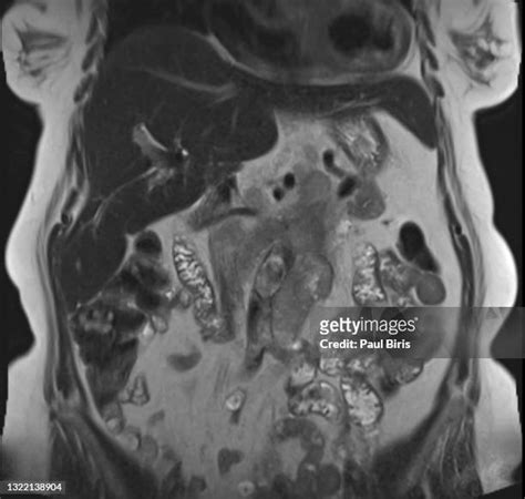 Enlarged Spleen Photos And Premium High Res Pictures Getty Images