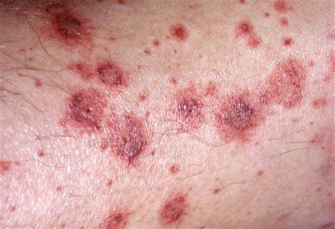 Vasculitis Lesions