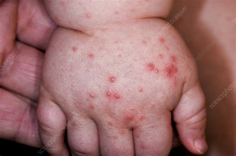 Hand Foot And Mouth Disease Stock Image C0345532 Science Photo